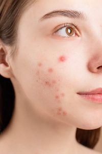 Een Stralende Huid in Den Haag: Tips voor een Succesvolle Acne Behandeling